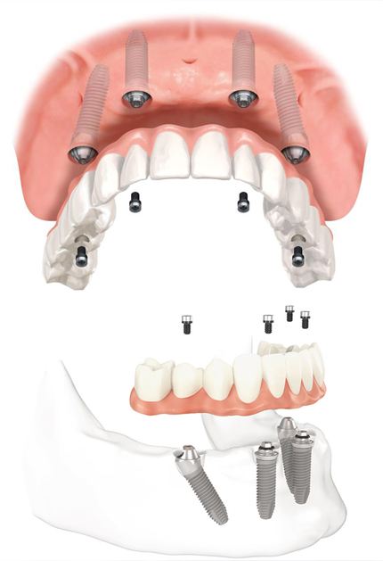 advance-dentist2-orali-Dentista-Porto-Alegre-Odonto-Clinica-Odontologica-em-Implante-Dentario-Odontologia-Dentaria-Dental-Restauração-Tratamento-Canal-Dentaduras-Prótese-Fixa-Móvel-All-on-Four-Bruxismo-Clareamento-Dentadura