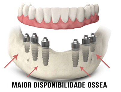 Implantes-Dentarios-Protese-Total2-Dentista-Porto-Alegre-Odonto-Clinica-Odontologica-em-Implante-Dentario-Odontologia-Dentaria-Dental-Restauração-Tratamento-Canal-Dentaduras-Prótese-Fixa-Móvel-All-on-Four-Bruxismo-Clareamento-Dentadura