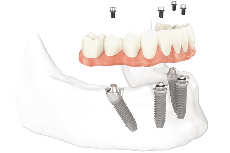 tudo-em-quatro-implantes-dentarios2-Dentista-Porto-Alegre-Odonto-Clinica-Odontologica-em-Implante-Dentario-Odontologia-Dentaria-Dental-Restauração-Tratamento-Canal-Dentaduras-Prótese-Fixa-Móvel-All-on-Four-Bruxismo-Clareamento-Dentadura